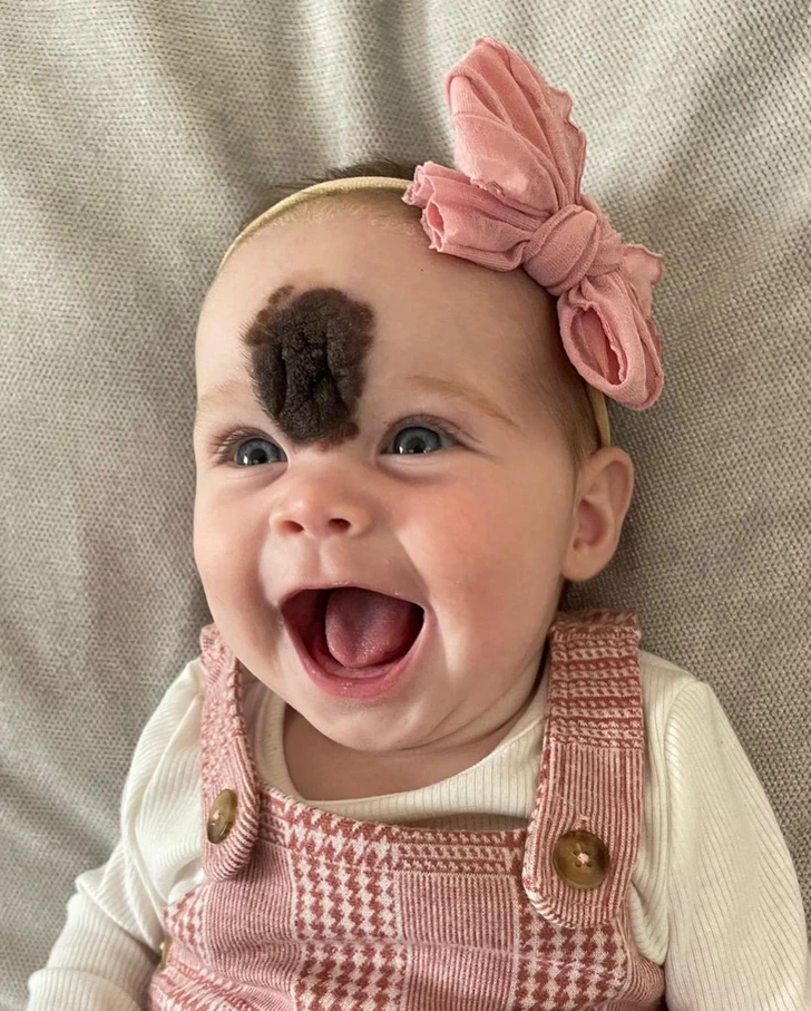 Babygirl with a birthmark. 